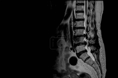 Téléchargez les photos : Scan of lumbosacral spine in lateral projection shown spinal canal stenosis .Decrease in disc space , bony spur formation and blank area at right side. spinal cord compression. - en image libre de droit