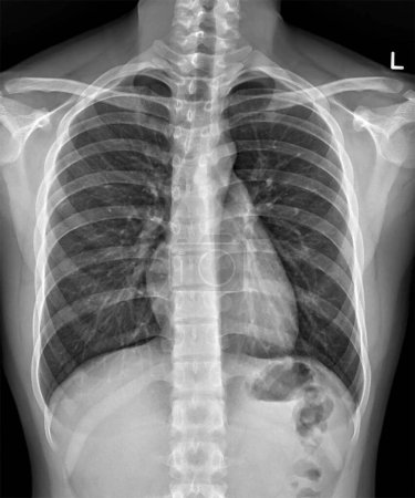 Téléchargez les photos : Plain radiograph on dark background in hospital. The film use for diagnosis the illness of patient.Medical concept.Normal chest x ray.Xray for diagnosis of pneumonia, tuberculosis TB and silicosis. - en image libre de droit