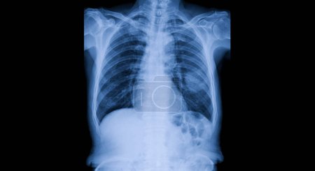 Foto de The radiograph on dark background in a hospital.X-ray is used for the diagnosis of the illness of the patient.Medical concept.Blue tone xray show mass at the left lung.Lung cancer in smoking patient. - Imagen libre de derechos