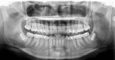 Téléchargez les photos : Radiographie dentaire panoramique montrant un joint d'amalgame à dents fixes.Radiographie pour les problèmes dentaires chez les patients souffrant de maux de dents ou de traumatismes après un accident pour le diagnostic de fracture de la mandibule.. - en image libre de droit