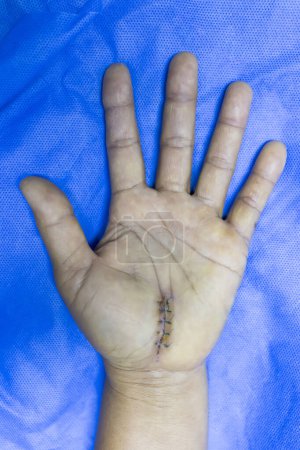 Téléchargez les photos : La main gauche de la femme après une chirurgie de libération du canal carpien ouvert sur drapé chirurgical bleu avec incision chirurgicale.Les points de suture sont restés dans la paume après la chirurgie qui se préparent pour le déménagement.. - en image libre de droit
