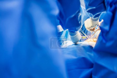 Team of doctor or surgeon in blue uniform did surgery inside operating room in hospital.People working with patient.Focus at hand with gloves and medical instrument.Light effect with blur background.