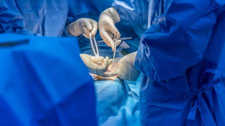Médico o cirujano hizo la cirugía de la operación de reparación de la malla de la hernia dentro del quirófano en hospital. Reparación abierta de hernia inguinal en pacientes con masa inguinal. El dispositivo de malla médica se usó con fondo borroso..