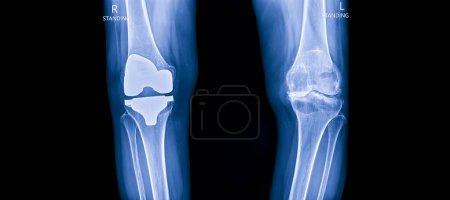 Blauton des Röntgenbildes in der orthopädischen Abteilung des Krankenhauses auf schwarzem Hintergrund. Röntgenbild zur Diagnose von Knieschmerzen.Gesamte Kniegelenkersatzprothesentechnologie bei Arthrose oder Oa-Knie.