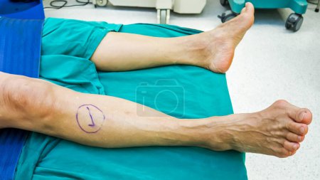 Photo for Check mark at right leg inpatient inside operating room.Hallux valgus or bunion surgery.Patient safety and wrong site procedure.Lawsuit and insurance.Medical concept. - Royalty Free Image