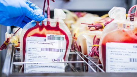 Leukozytenarme verpacken rote Zellen in Transfusionsbeutel auf einem Tablett innerhalb der Blutbank. Kennzeichnung als B Rh plus. Seltene Blutgruppe bereitet sich auf die Spende oder Therapie von Anämiepatienten im Krankenhaus.Viele Plastiktüten.