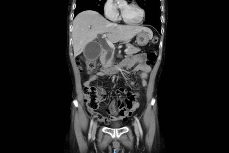 Foto de Tecnología de tomografía computarizada en pacientes quirúrgicos con dolor abdominal.Se puede detectar masa o tumor hepático.Unidad de radiología médica de investigación oncológica.. - Imagen libre de derechos