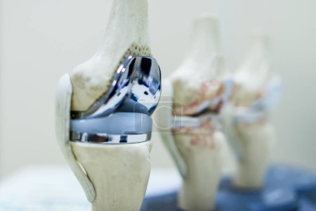 Foto de Modelo de articulación de rodilla o maqueta con prótesis de reemplazo de rodilla en pacientes con osteoartritis o dolor de rodilla. Médico ortopédico o cirujano explica acerca de la cirugía.Enfoque selectivo con fondo borroso. - Imagen libre de derechos