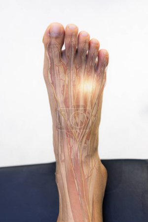 Orthopäde oder Chirurg untersuchten den Patienten mit Taubheit des Fußes. Fußschmerzen beim Morton-Neuroma-Syndrom mit transparenter Anatomie der Nerven. Leichte Wirkung auf weißem Hintergrund. Taubheit und Schmerzen des Fußes.
