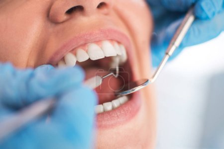 Foto de Abra la boca femenina durante el chequeo bucal en el dentista. Enfoque selectivo. - Imagen libre de derechos