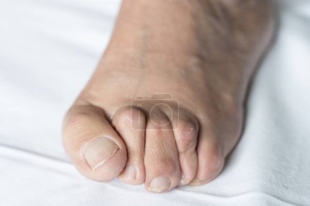 El juanete al pie del hombre mayor con los dedos de los pies de martillo y la piel seca sobre el fondo blanco. Higiene, cirugía, atención médica, podólogo, conceptos dermatológicos