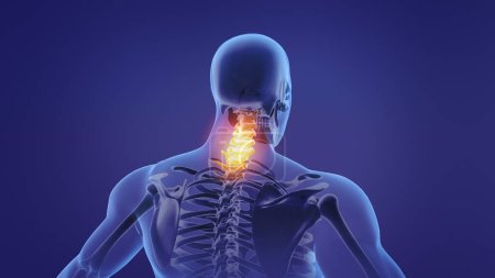 Photo for Animation of a painful neck - Royalty Free Image