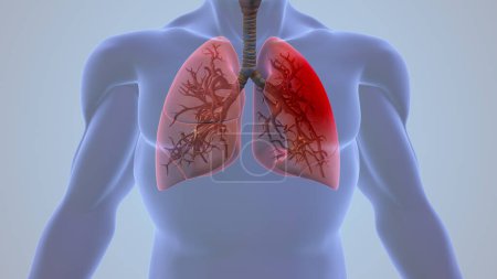 Human Pleurisy Lung Inflammation Pain