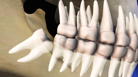 Concept of wisdom teeth pain