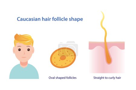 Ilustración de Infographic of Caucasian hair follicle shape vector illustration isolated on white background. Cross section of oval shaped follicles. Straight to curly hair with scalp layer. Hair anatomy concept illustration. - Imagen libre de derechos