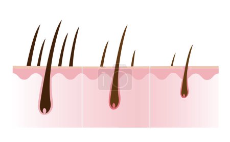 Ilustración de Step of hair losing with scalp layer vector isolated on white background. Reduce, decrease, thin, remove, fall hair to alopecia, baldness and hairless. Hair anatomy concept illustration. - Imagen libre de derechos