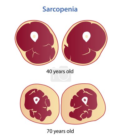 Téléchargez les illustrations : Sarcopenia, loss muscle mass and strength vector illustration isolated on white background. Cross section of loss muscle mass of sedentary man in different ages. Anatomy and health care concept illustration. - en licence libre de droit