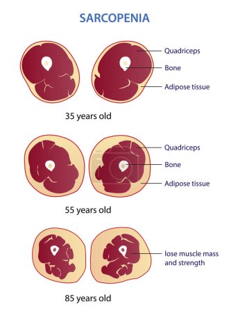 Ilustración de Infographic of sarcopenia vector illustration isolated on white background. Cross section of losing muscle mass and strength in different age. Anatomy and health care concept illustration. - Imagen libre de derechos