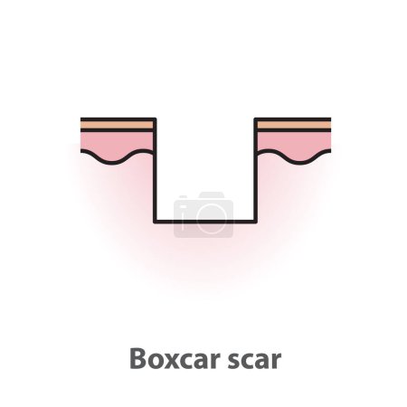 Téléchargez les illustrations : Boxcar scar, atrophic scar, type of acne scar on skin surface with color and line vector isolated on white background. Skin care and beauty concept. Flat icon illustration. - en licence libre de droit