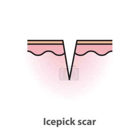 Téléchargez les illustrations : Icepick scar, atrophic scar, type of acne scar on skin surface with color and line vector isolated on white background. Skin care and beauty concept. Flat icon illustration. - en licence libre de droit