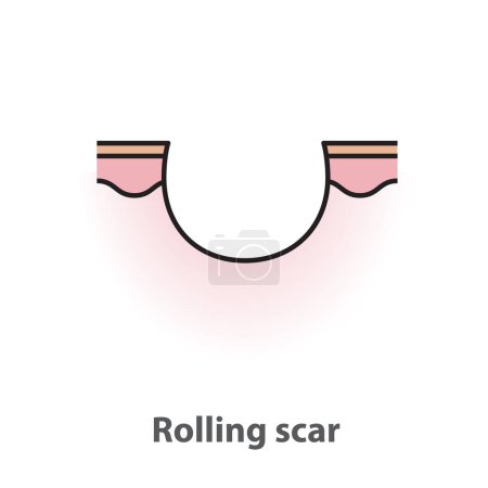 Téléchargez les illustrations : Rolling scar, atrophic scar, type of acne scar on skin surface with color and line vector isolated on white background. Skin care and beauty concept. Flat icon illustration. - en licence libre de droit