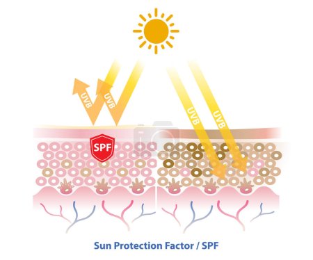 Illustration for SPF (Sun protection factor) blocks UVB radiation penetrate into the skin layer vector on white background. Comparison of skin with sunscreen and no sunscreen. Skin care and beauty concept illustration. - Royalty Free Image