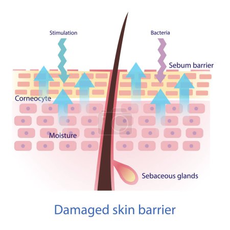 Illustration for Damaged skin barrier vector. The sebum barrier decreased, tight arrangement between the skin cells is lost. This allows external irritants to get in skin a lot easier and lead to more water leaving skin. Skin care and beauty concept illustration. - Royalty Free Image