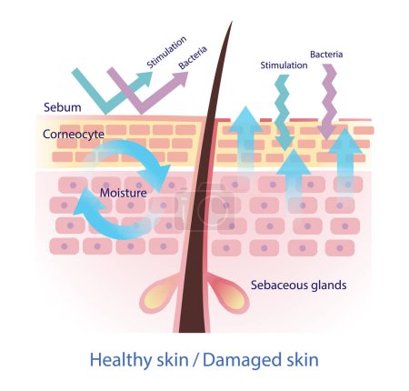 Ilustración de Comparison of healthy and damaged skin barrier vector on white background. The healthy sebum barrier protect skin from stimulation and bacteria. When sebum decreased, this lead to more water leaving skin. Skin care and beauty concept illustration. - Imagen libre de derechos