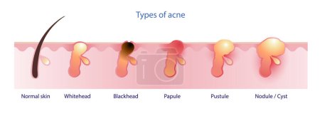 Illustration for Types of acne vector isolated on white background. Formation of normal skin, acne, pimple, comdone, non inflammation acne, whitehead, blackhead, inflammation acne, papule, pustule, nodule and cyst. Skin illustration. Skin care and beauty concept. - Royalty Free Image