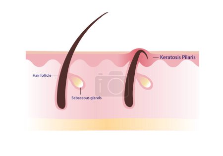 Illustration for Keratosis Pilaris. Chicken skin vector on white background. Hair has grown back into the skin surface illustration. Atopic Dermatitis Infographic. - Royalty Free Image