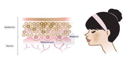 Illustration for The mechanism of melasma skin vector on white background. Infographic illustration of woman face and skin layer. Skin care and beauty concept. - Royalty Free Image