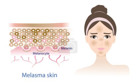 Illustration for Infographic of woman face with melasma skin vector on white background. The mechanism of melasma skin vector. Skin care and beauty concept illustration. - Royalty Free Image