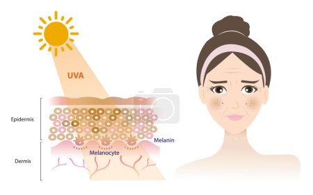 Téléchargez les illustrations : UVA rays penetrate into the dermis skin layer, damage woman face, resulting in a tan, melasma, aging, wrinkle, dark spots vector isolated on white background. Skin care concept illustration. - en licence libre de droit