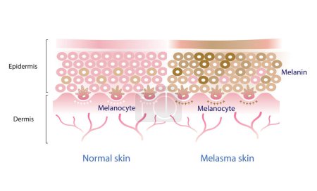 Ilustración de Normal skin layer and melasma skin layer vector, melanocyte, melanin, melanogenesis vector on white background. - Imagen libre de derechos
