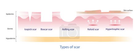 Téléchargez les illustrations : Types of  scar vector, icepick scar, boxcar scar, rolling scar, keloid scar and hypertrophic scar on white background. - en licence libre de droit