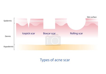 Téléchargez les illustrations : Types of acne scar vector on white background. Cross section of icepick scar, boxcar scar and rolling scar with skin layer. Skin care and beauty concept illustration. - en licence libre de droit