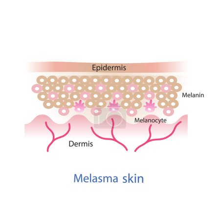 Ilustración de El mecanismo del vector de piel de melasma. Belleza cuidado de la piel concepto ilustración. - Imagen libre de derechos