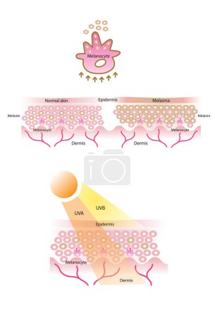 Ilustración de Melanocitos, melanina, vector de melanogénesis y capa de piel normal, capa de piel melasma, capa de piel con UVA y UVB sobre fondo blanco. - Imagen libre de derechos
