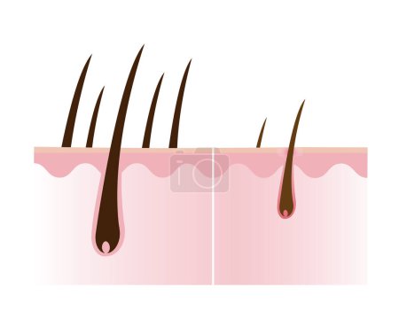 Ilustración de Comparison of healthy and losing hair with scalp layer vector isolated on white background. Hair density, loss, alopecia, baldness and hairless. Hair anatomy concept illustration. - Imagen libre de derechos