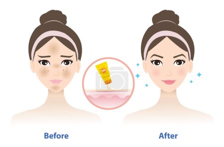 Illustration for Before and after get used sunscreen vector isolated on white background. Comparison of woman face with melasma and the better result of wearing sunscreen on face. Skin care and beauty concept illustration. - Royalty Free Image