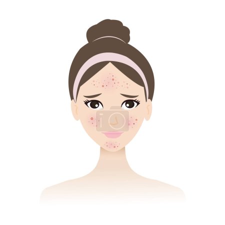 The woman face with skin acne vector isolated on white background. Acne, pimples, blackheads, comedones, whiteheads, papule, pustule, nodule and cyst on face. Non inflammation and inflammation acne. Skin problem concept illustration.