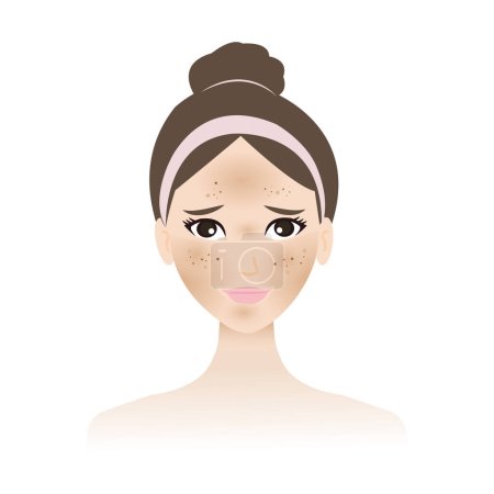 L'hyperpigmentation et le mélasme sont sur le vecteur facial de la femme isolé sur fond blanc. Un brun foncé et des taches sont présentes sur le visage, les joues, le nez, la lèvre supérieure et le front. Illustration de concept de problème de peau.