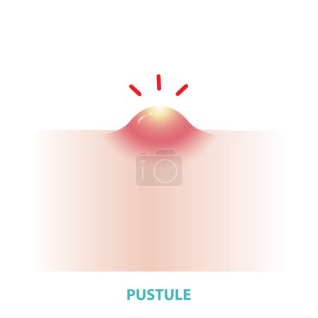 Illustration for Pustule acne vector isolated on white background. Formation of inflammatory acne, pustule, small blister or pimple on the skin inflamed and containing pus. Flat design vector acne illustration. Skin care and beauty concept. - Royalty Free Image