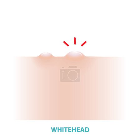 Illustration for Whitehead acne vector illustration isolated on white background. Formation of comedone, whitehead, a pale or white-topped pustule on the skin. Flat design vector acne illustration. Skin care and beauty concept. - Royalty Free Image