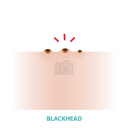 Illustration for Blackhead acne vector isolated on white background. Formation of comedone, blackhead, a plug of sebum in a hair follicle, darkened by oxidation on the skin. Flat design vector acne illustration. Skin care and beauty concept. - Royalty Free Image