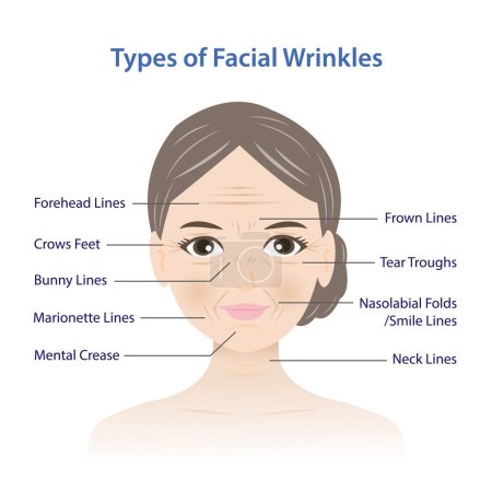 Illustration for Types of facial wrinkles vector illustration isolated on white background. Forehead, Bunny, Marionette, Frown lines, Mental crease, Crows feet, Tear troughs, Nasolabial folds, Smile and Neck lines on woman face. - Royalty Free Image