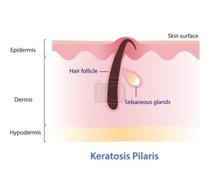 Illustration for Keratosis Pilaris. Ingrown hair, Chicken skin vector illustration isolated on white background. Hair has grown back into the skin surface. Bumpy skin that looks like tiny pinpricks or goosebumps. Atopic Dermatitis Infographic. - Royalty Free Image