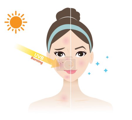 Illustration for UVB rays penetrate into the woman face, resulting in burn, inflammation, aging, wrinkle, photoaging and red spots vector isolated on white background. Comparison of damaged and beauty skin. Skin care concept illustration. - Royalty Free Image