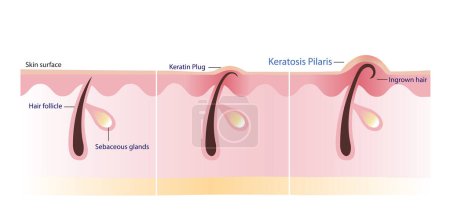 Der Prozess der Keratosis Pilaris Vektorillustration isoliert auf weißem Hintergrund. Querschnitt durch Keratin-Stecker, eingewachsenes Haar, Hühnerhaut und holprige Haut. Atopische Dermatitis Infografik.
