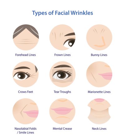 Illustration for Types of facial wrinkles vector icon set illustration isolated on white background. Icon set of Forehead, Bunny, Marionette, Frown lines, Mental crease, Crows feet, Tear troughs, Nasolabial folds, Smile and Neck lines. - Royalty Free Image